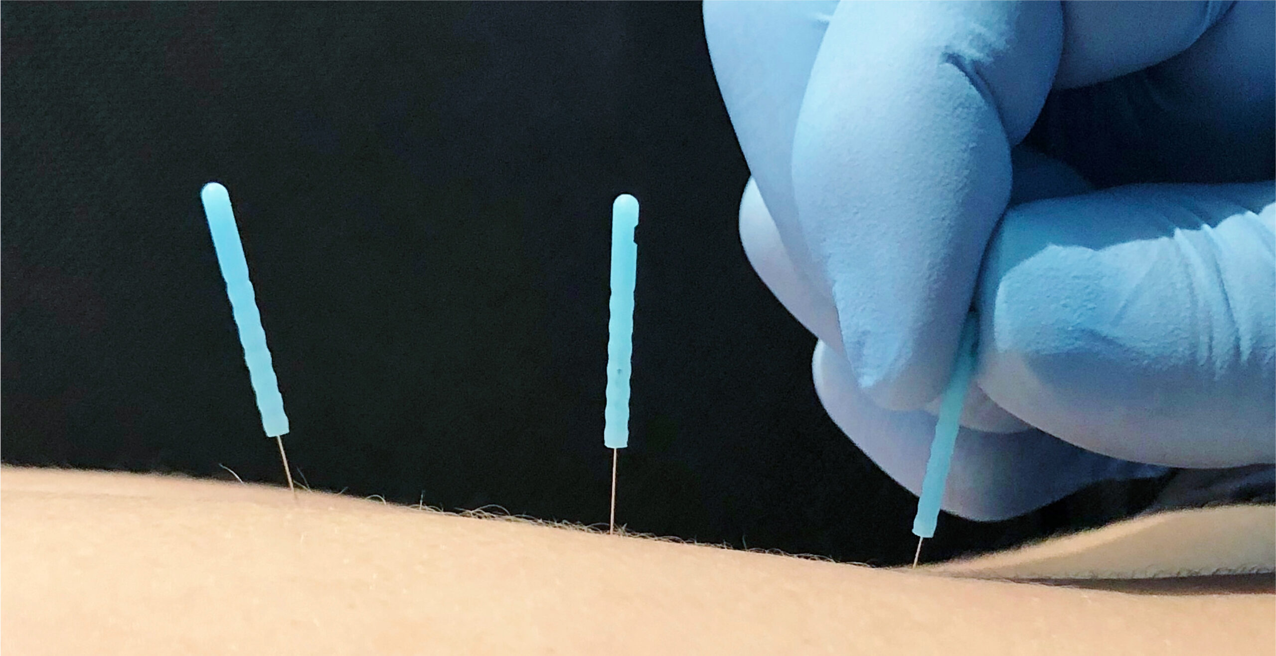 Dry Needling